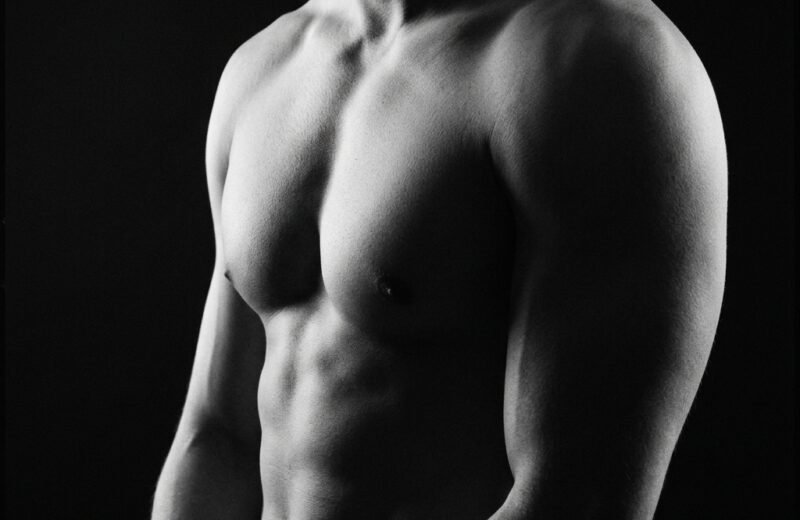 Gynecomastia